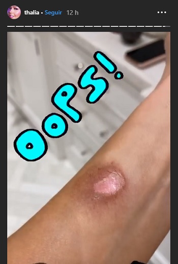 Thalía se quema el brazo con una vela de torta