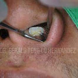 Hombre le creció un diente en la nariz